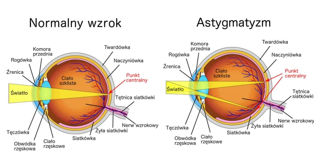 Skąd się bierze astygmatyzm? Poznaj przyczyny i objawy tej wady wzroku