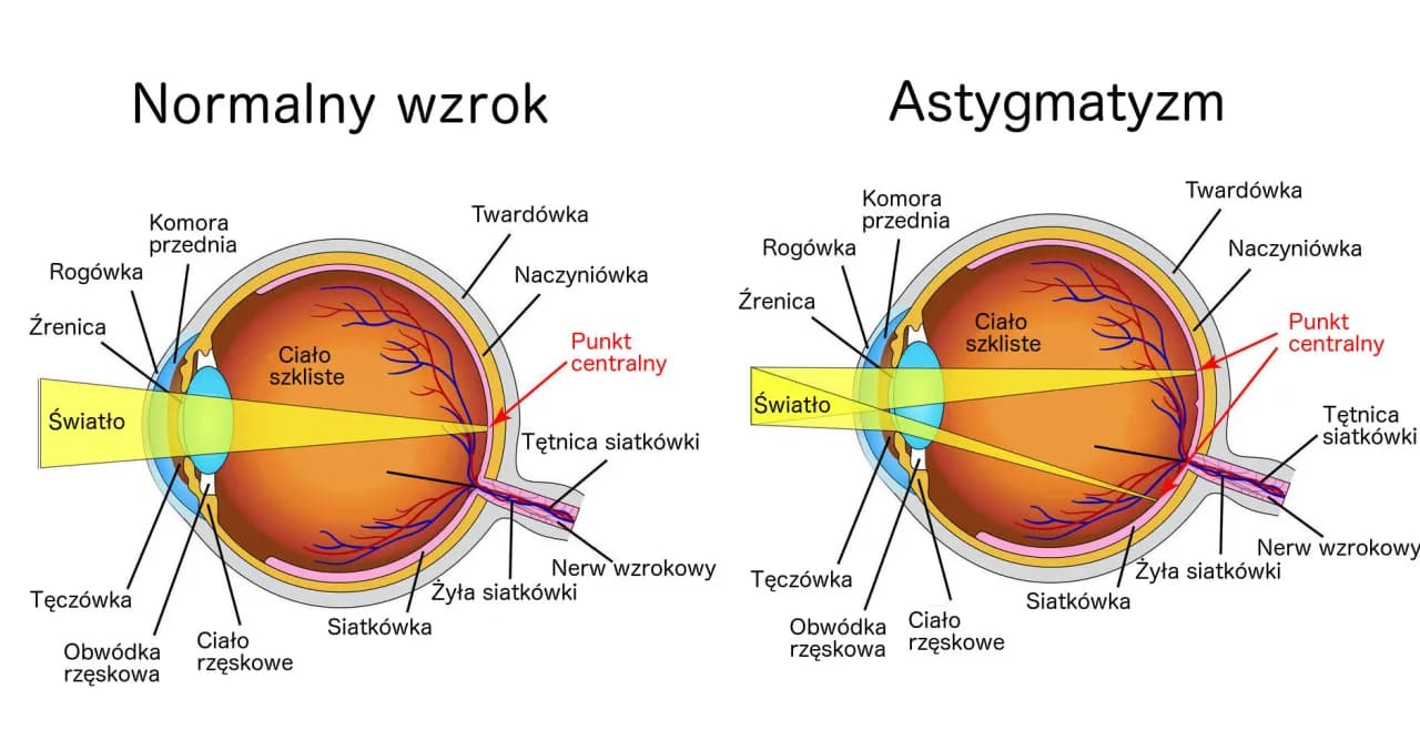 Skąd się bierze astygmatyzm? Poznaj przyczyny i objawy tej wady wzroku