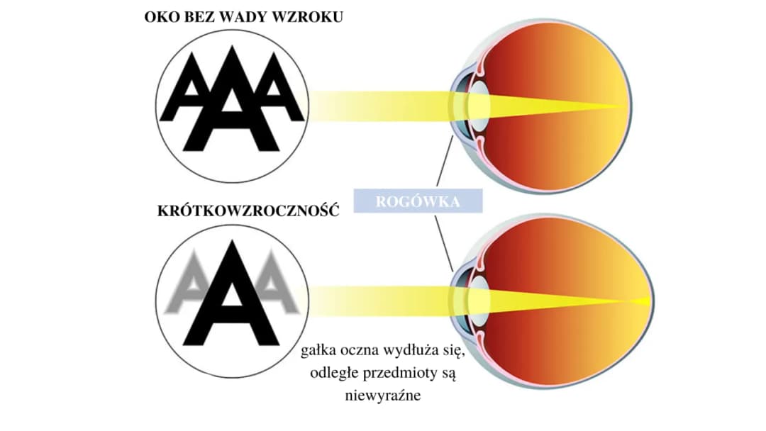 Jaka soczewka na krótkowzroczność? Wybierz najlepszą dla siebie!