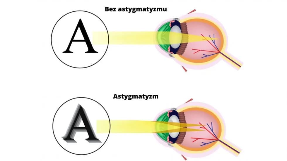 Astygmatyzm jak widzi światła – zrozum, co widzisz i jak to leczyć