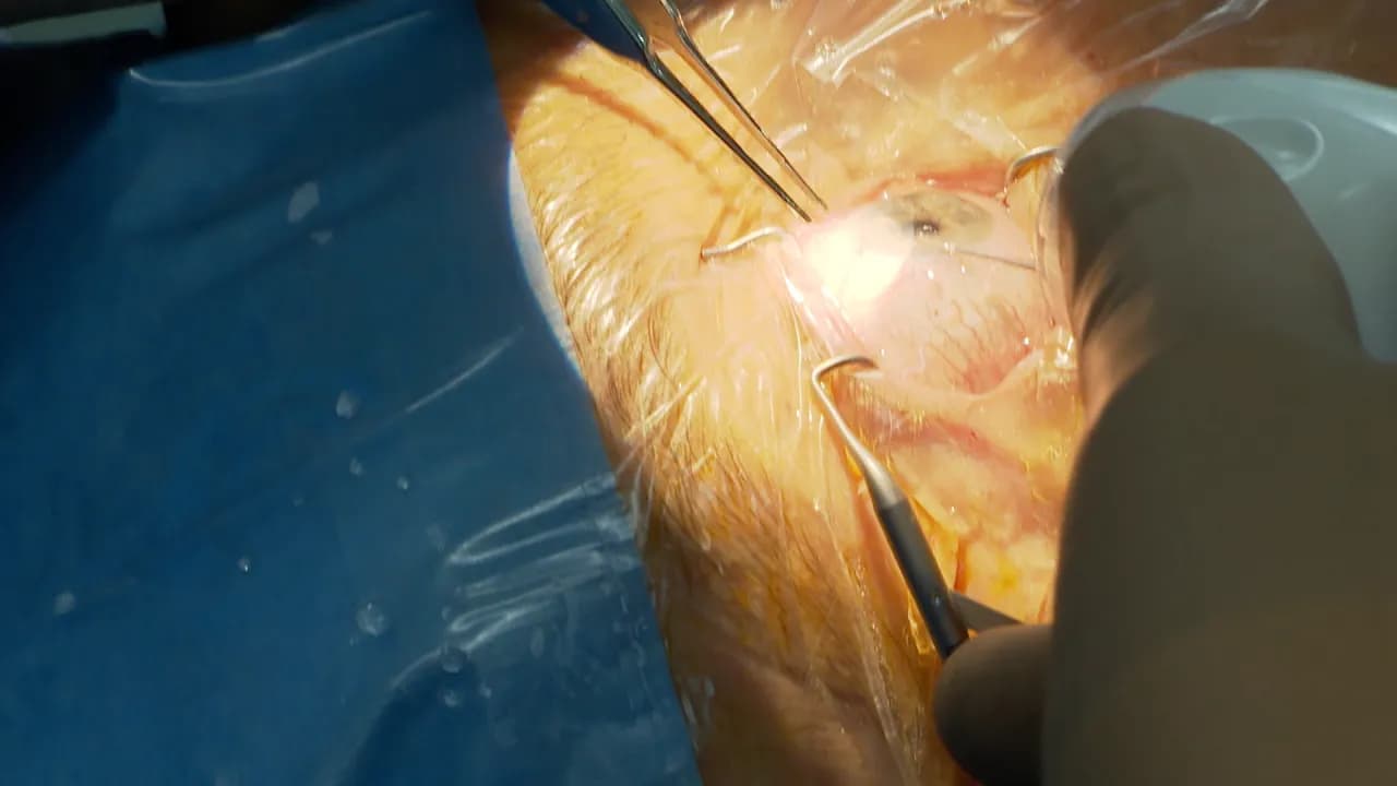 Jak długo trwa rehabilitacja po operacji jaskry? Oczekiwania i porady