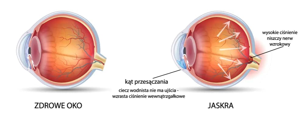 Jak sprawdzić czy mam jaskrę? Objawy i ważne badania, które ratują wzrok