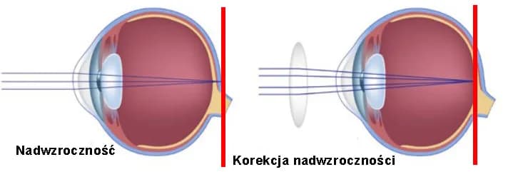 Maksymalna wada wzroku: co musisz wiedzieć o dioptriach i ich skutkach