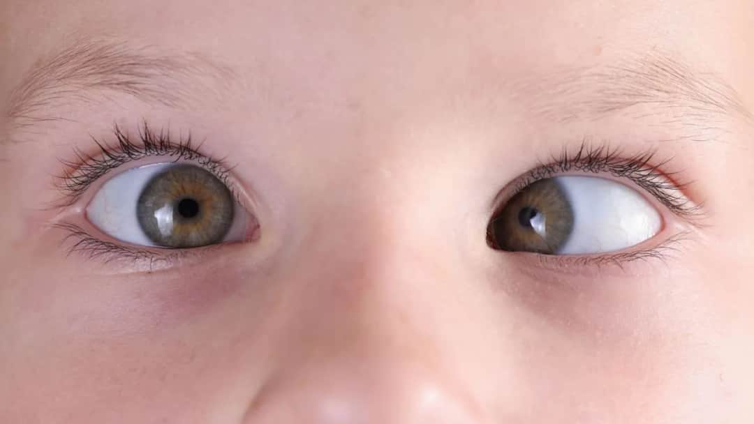 Skuteczne metody leczenia zeza rozbieżnego – uniknij problemów ze wzrokiem