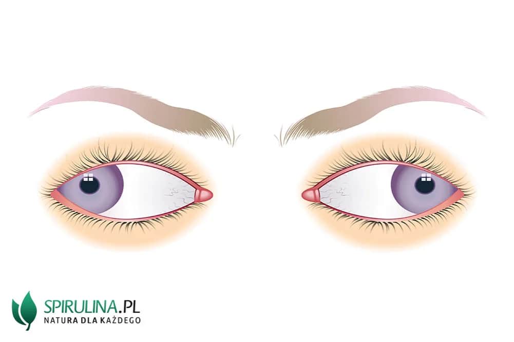 Co to jest zez rozbieżny? Objawy, przyczyny i skuteczne leczenie