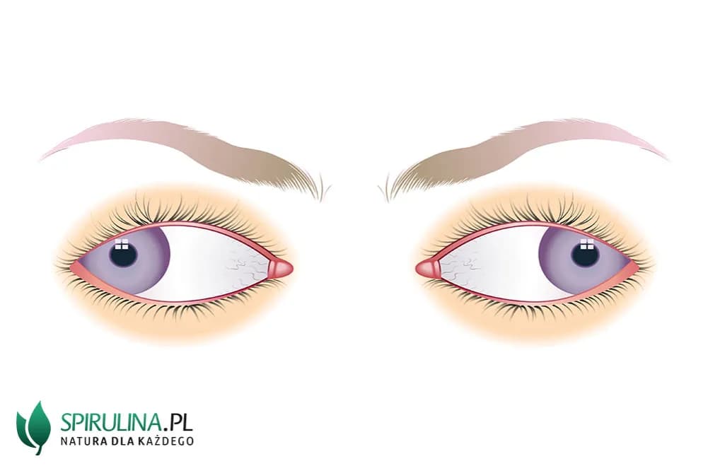 Co to jest zez rozbieżny? Objawy, przyczyny i skuteczne leczenie