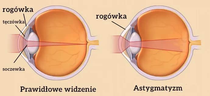 Czy astygmatyzm może się zmniejszyć? Poznaj prawdę o leczeniu i wieku