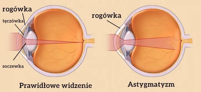 Czy astygmatyzm może się zmniejszyć? Poznaj prawdę o leczeniu i wieku