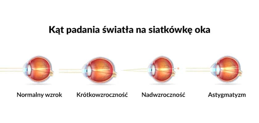 Jakie soczewki na astygmatyzm wybrać - kompletny poradnik dla pacjentów