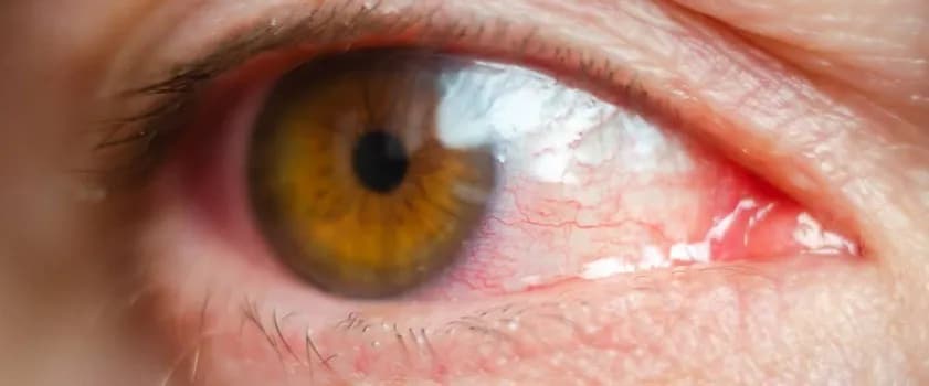 Co na przekrwione oczy? Poznaj przyczyny i skuteczne metody leczenia