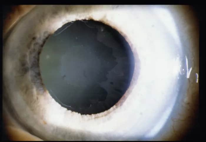 Jakie są objawy jaskry barwnikowej i jak je rozpoznać?