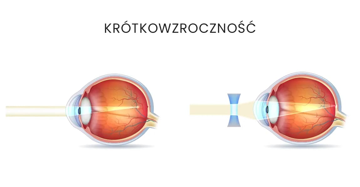 Jak wyleczyć krótkowzroczność i poprawić jakość widzenia?
