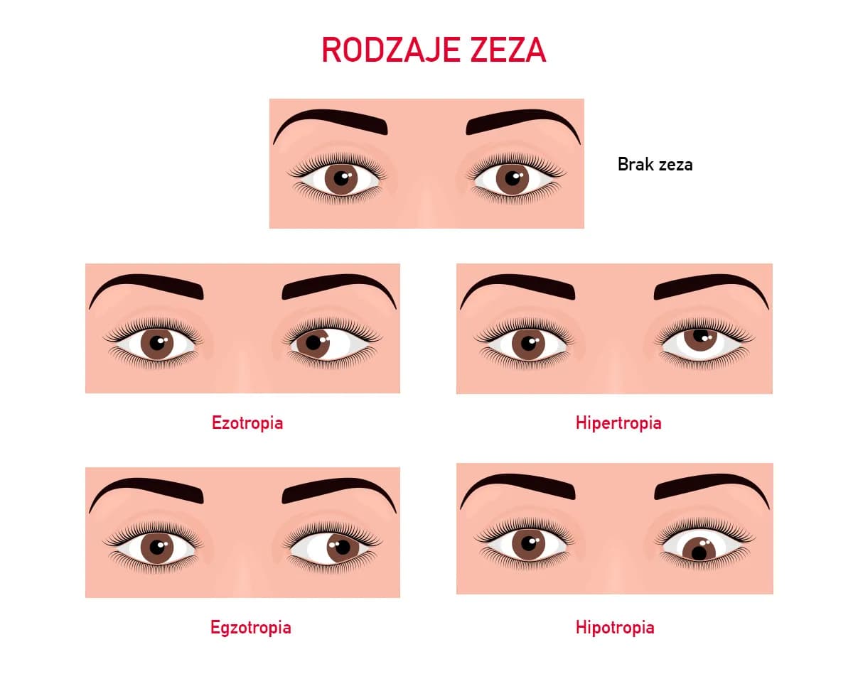 Zez ukryty u dziecka objawy: jak je rozpoznać i kiedy działać
