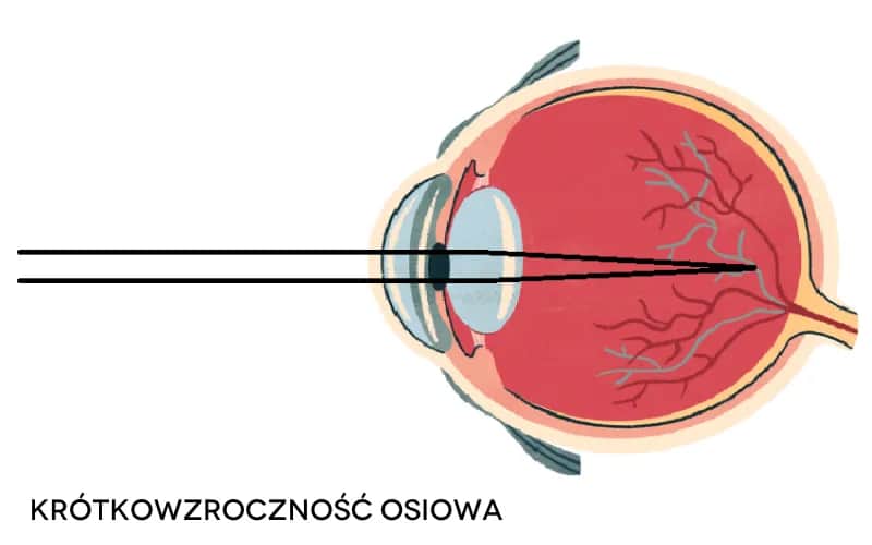 Czy wada wzroku minus może się cofnąć: Prawda o leczeniu krótkowzroczności