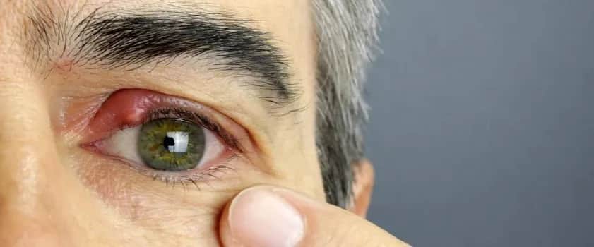 Jak wyleczyć jęczmień na oku: skuteczne domowe sposoby i porady
