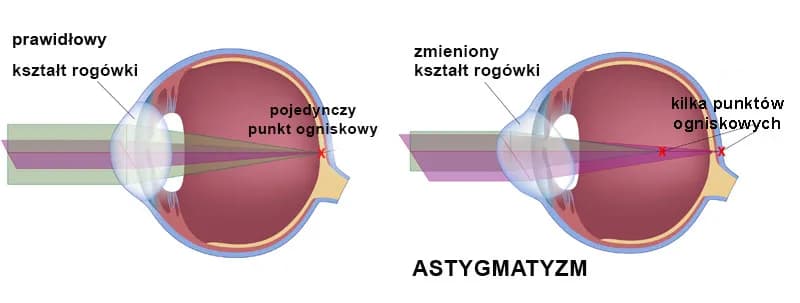 Czy można wyleczyć minusową wadę wzroku: fakty i skuteczne metody leczenia