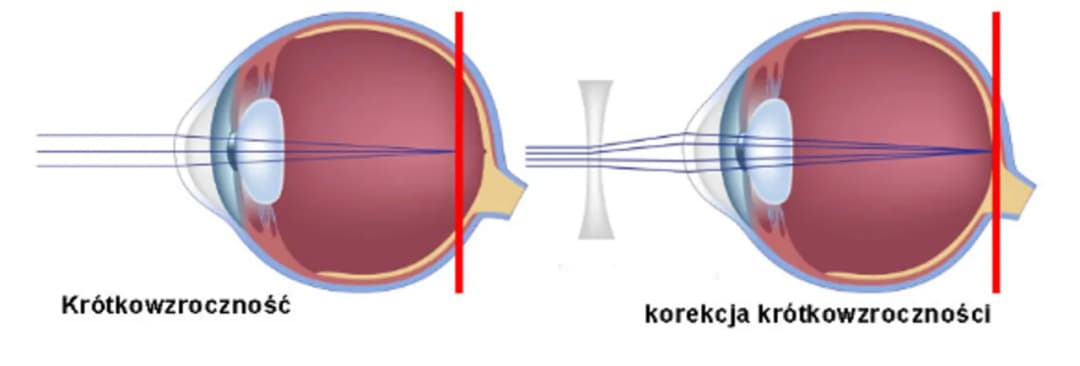 Jakie wady wzroku mogą się cofnąć? Fakty i skuteczne metody